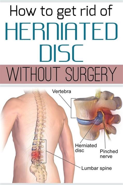 How to get rid of herniated disc without surgery. | Herniated disc, Herniated disc lower back ...