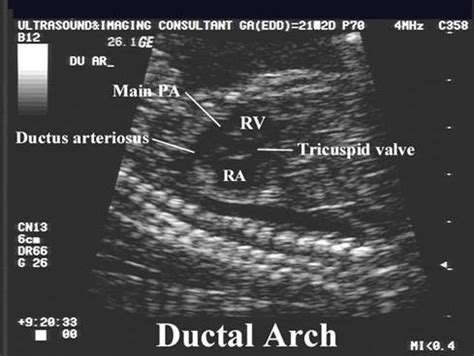 Ductus Arteriosis