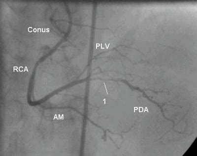 Dominant right coronary artery - Medicine MCQ « PG Blazer