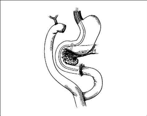 Hepaticojejunostomy Using Short-Limb Roux-en-Y Reconstruction | Surgery | JAMA Surgery | JAMA ...