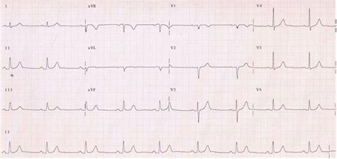 Continuous Ambulatory ECG | Heart Health | OneWelbeck