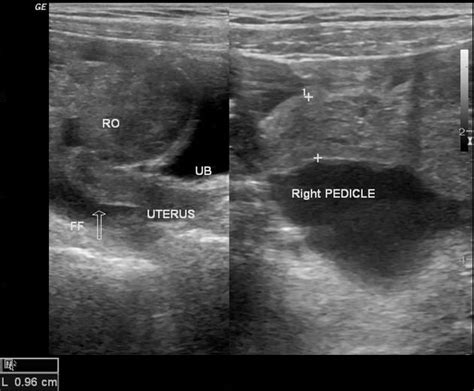 Ovarian torsion | Radiology Case | Radiopaedia.org | Ovarian, Ovarian torsion, Radiology