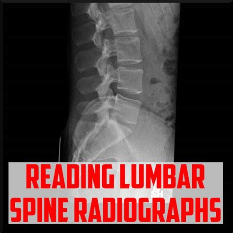 A Review on Reading Lumbar X-rays - Sports Medicine Review