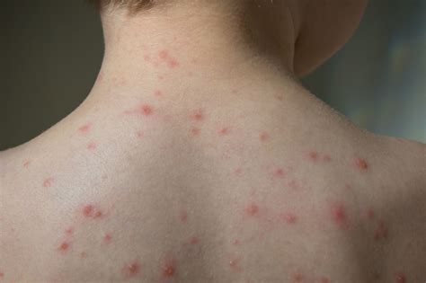 Chickenpox Outbreak at School Linked to Vaccine Exemptions | Primary Care Collaborative