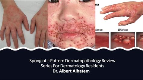 Dermatopathology Lesson 1- Spongiotic Dermatitis (Tissue Reaction ...