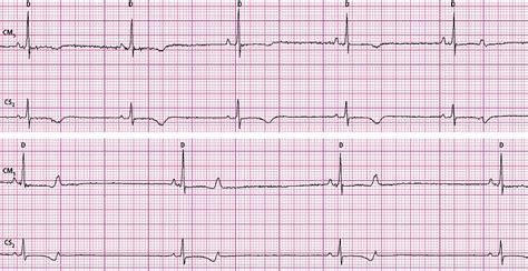 Sinus Bradycardia