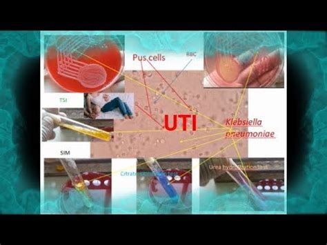 Pus cells ,Klebsiella in Urine of Urinary tract infection /UTI patient - YouTube