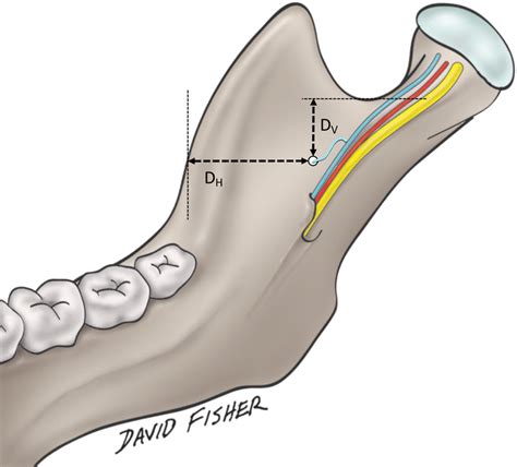 Measurement of the accessory mandibular foramen | Download Scientific Diagram