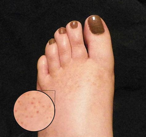 Causes of Red Dots on Feet | hubpages