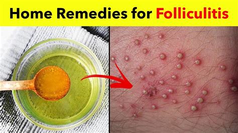 Folliculitis Treatment At Home