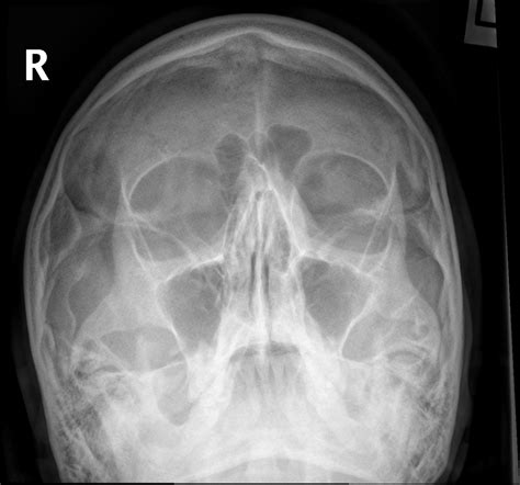 Pns Anatomy Radiology