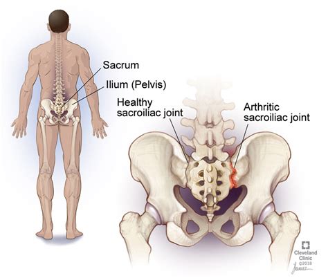 What is a Sacroiliac Joint Injection? - Integrative Pain & Spine Institute