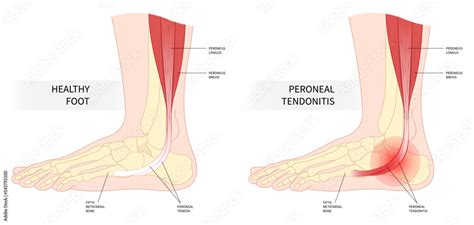 Vettoriale Stock foot peroneal tendonitis painful ankle torn tendon swollen trauma side sport ...