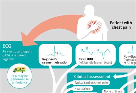 Acute coronary syndrome: Assessment of acute chest pain of suspected cardiac origin | The BMJ