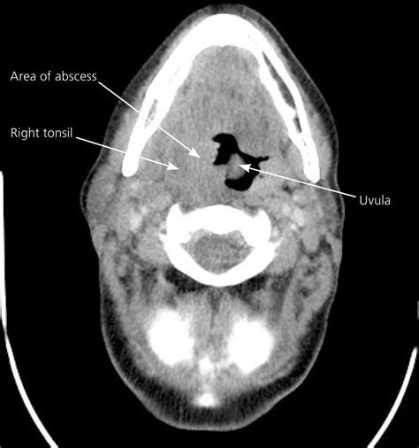 Peritonsillar Abscess | AAFP