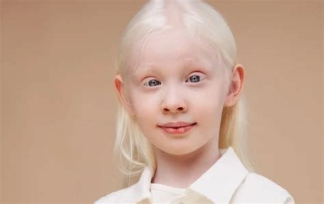 Study Reveals Why People with Albinism Have Poor Vision | OBN