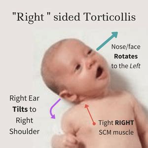 What is Torticollis at everythingbabies.org | Everything Babies! | Pediatric physical therapy ...