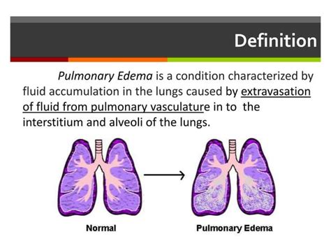 Pulmonary Oedema - Pathophysiology - Approach & Management