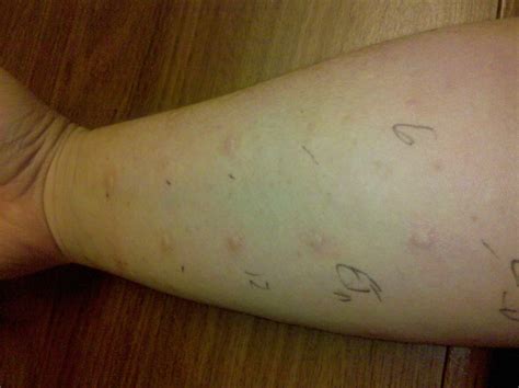 Allergy Prick Test | Allergies to a lot of things on this on… | Flickr