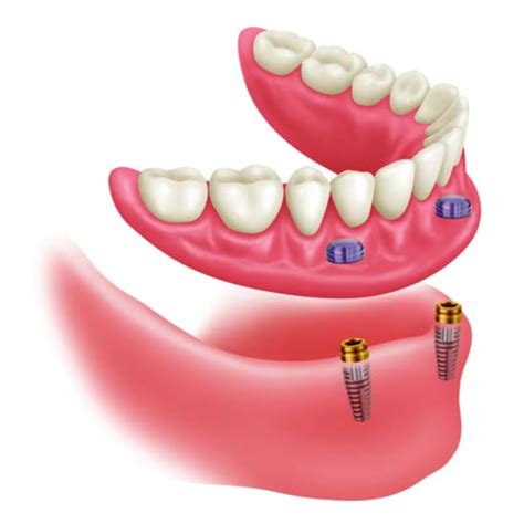 Zest Locator Abutments and Overdentures at RDL | Russellville Dental Lab