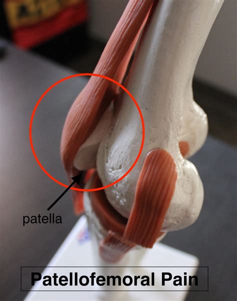 Achy Knees: What's Patellofemoral Pain (PFP)? - Pro Soccer to Physical ...