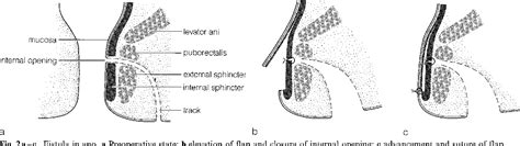 Figure 1 from The endorectal advancement flap procedure | Semantic Scholar