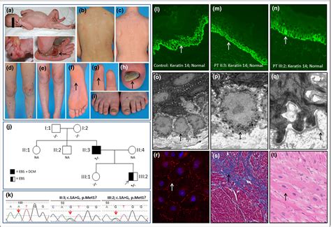 Epidermolysis Bullosa Uk