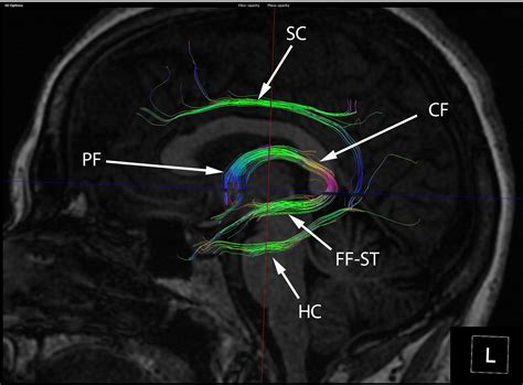 Diffusion Tractography of the Fornix | Neurography Institute