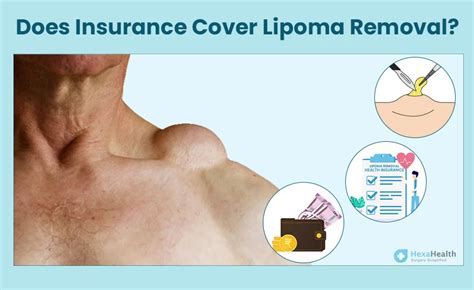 Is Lipoma Removal Surgery Covered by Insurance in India?