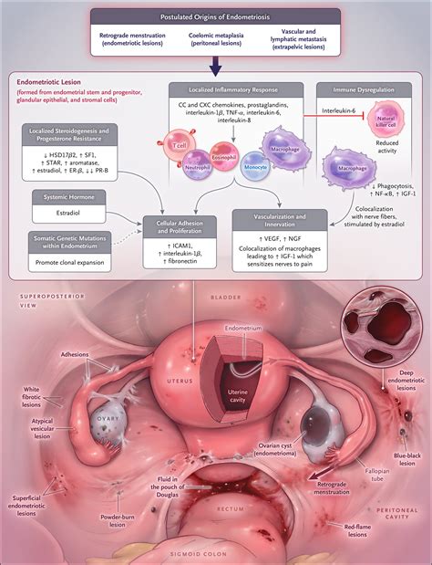 Endometriosis | NEJM