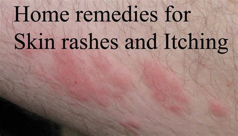 Best Home remedies for Skin rashes and Itching | Online bee | Home ...