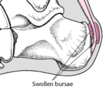 Low Level Laser Therapy for Foot Pain - Market Street Clinic