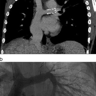 a) CT scan in coronal view. Patient after Fontan palliation and... | Download Scientific Diagram