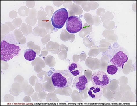 Centroblastic morphological variant - CELL - Atlas of Haematological Cytology