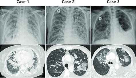 Chest X-ray and computed tomography (CT) findings: ground glass... | Download Scientific Diagram