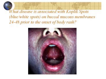 PPT – What disease is associated with Koplik Spots bluewhite spots on buccal mucous membranes ...