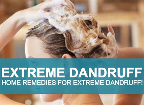 Natural Therapy, Home Remedies For Extreme Dandruff! Dandruff is one of ...