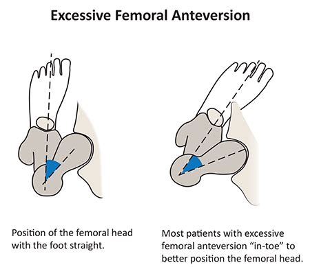 Hip/Femoral Anteversion | Physical therapy assistant, Physical therapy, Muscle anatomy