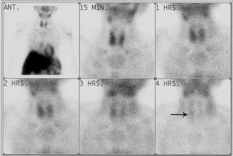 Parathyroid sestamibi scan (areas of tracer retention over upper and... | Download Scientific ...