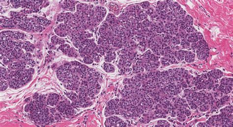 Atypical lobular hyperplasia of the breast | MyPathologyReport.ca