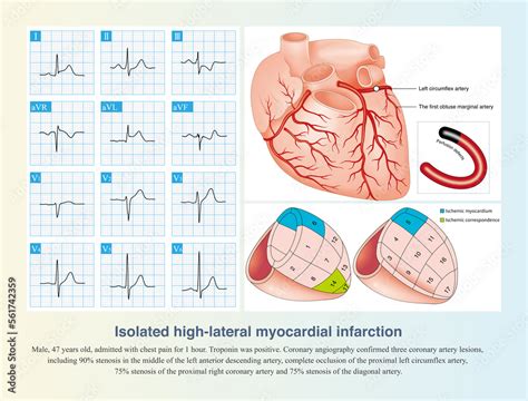 Isolated occlusion of left circumflex artery can lead to isolated high lateral myocardial ...