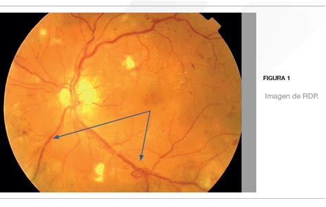 Retinopatía diabética proliferativa, ¿qué actitud terapéutica tomar ...