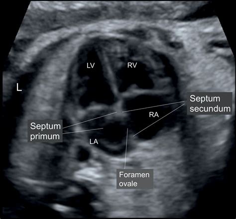 Cardiac Chambers: The Four-Chamber and Short-Axis Views | Obgyn Key | Medical ultrasound ...