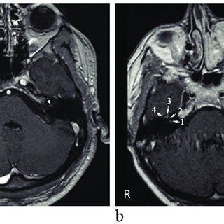 Contrast enhancement on T1-weighted axial MRI images a) Contrast... | Download Scientific Diagram