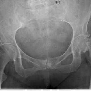 (PDF) A case report of missed femoral neck stress fracture