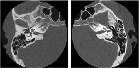 Bilateral osteomas and exostoses of the internal auditory canal | Ento Key