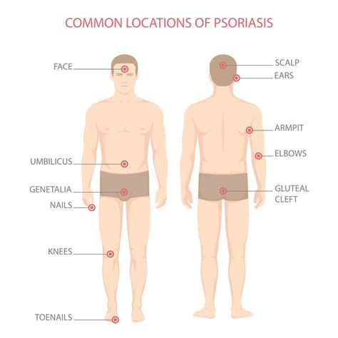 stages of psoriatic arthritis - Captions Prince