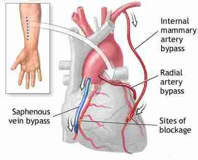 Why is LIMA graft superior to saphenous venous graft in CABG ? | Dr.S.Venkatesan MD