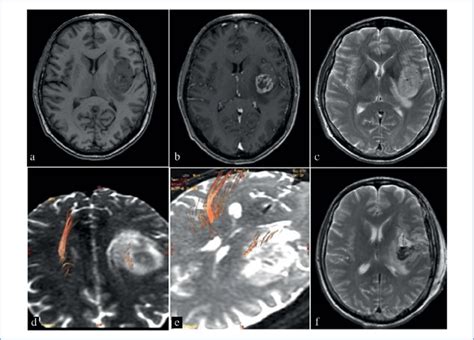 MRI of patient V. with tumor of the left insular lobe. a — Т1 prior to... | Download Scientific ...