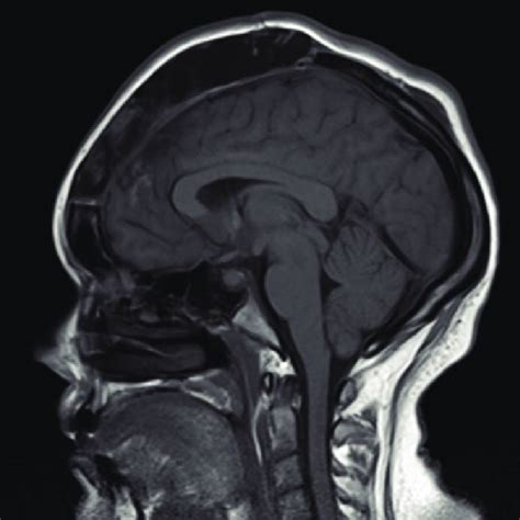 (PDF) Management of Cerebellar Tonsillar Herniation following Lumbar ...